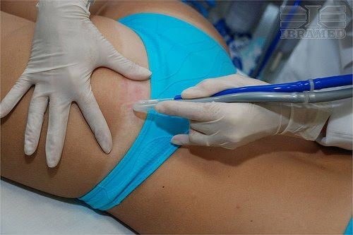ESTRIAS - PEELING CRISTAL